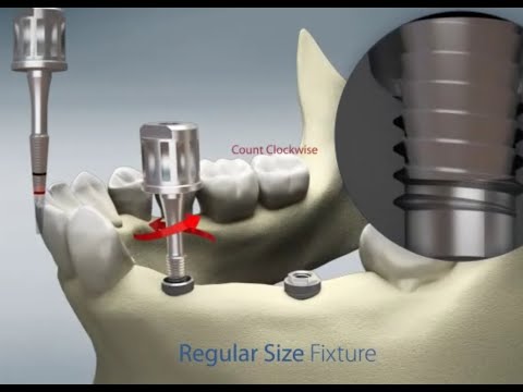 Dental Implant Remover (IRF)