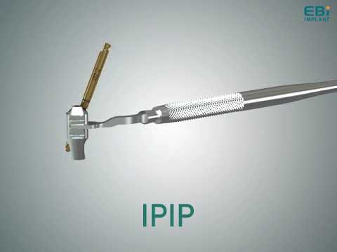 Dental Implant IPIP Kit