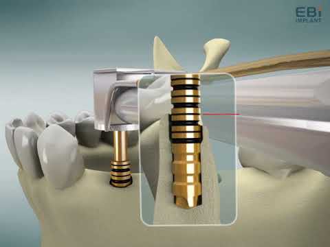 Dental Implant One More Drill [OMD]